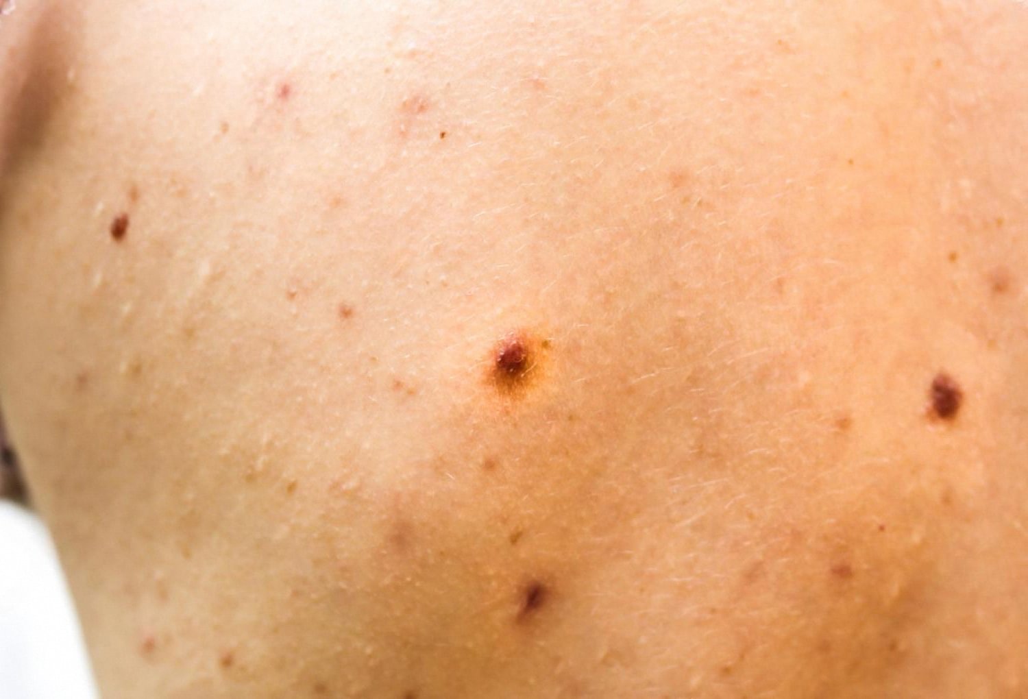 Close-up of skin with post-acne dark spots and pigmentation marks